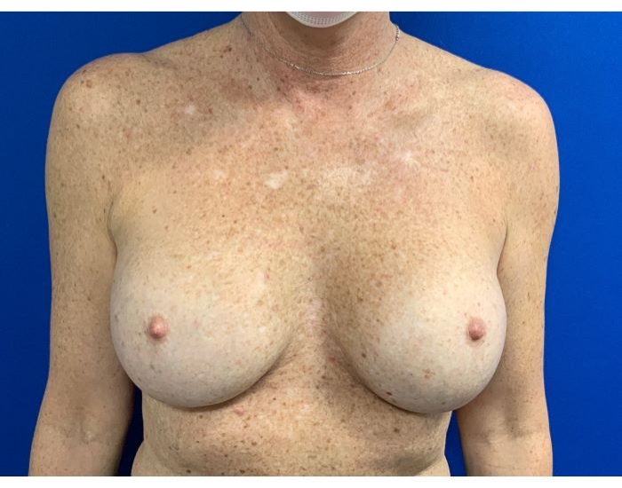 Direct to Implant Breast Reconstruction