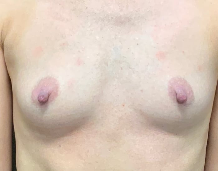 Before Image: Breast Augmentation