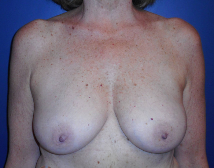 Cosmetic Breast Reduction